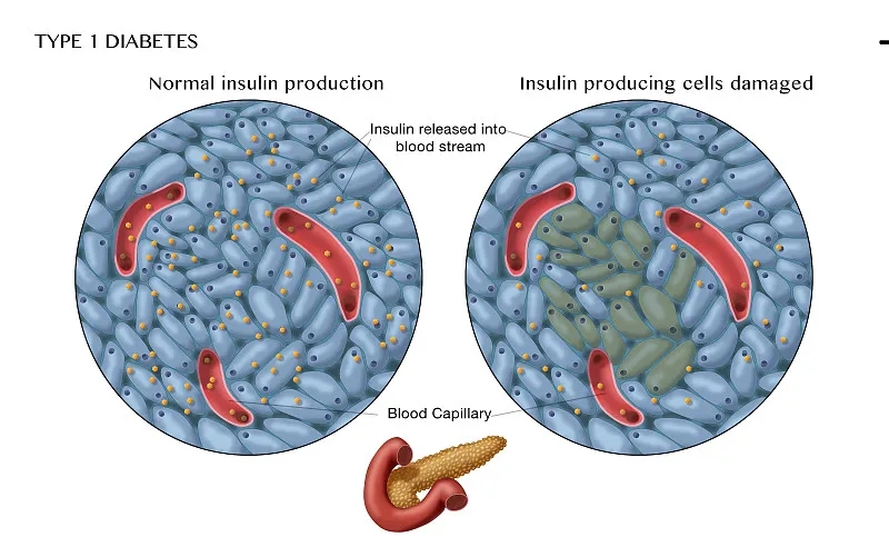 間充質干細胞在1型糖尿病治療中的作用
