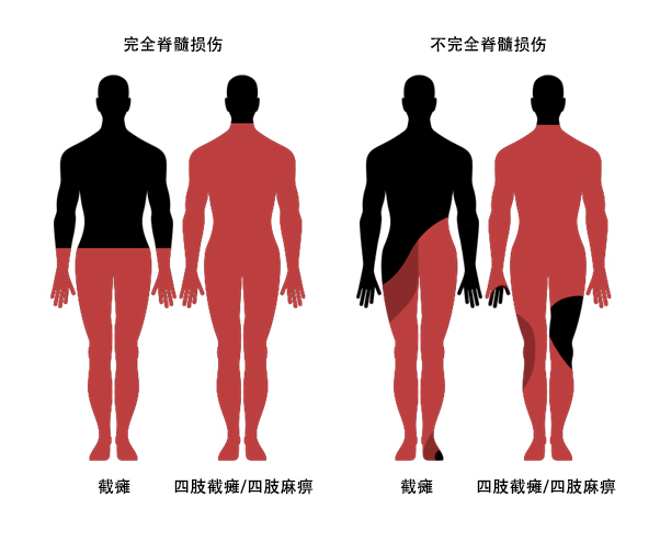 脊髓損傷并發癥 脊髓損傷并發癥