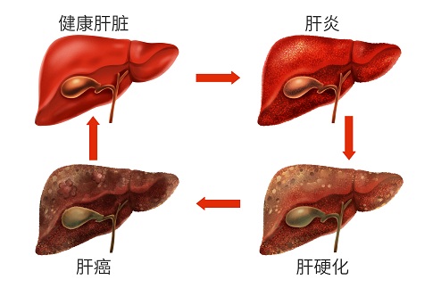 人臍帶血間充質干細胞移植治療失代償性肝硬化患者 人臍帶血間充質干細胞移植治療失代償性肝硬化患者