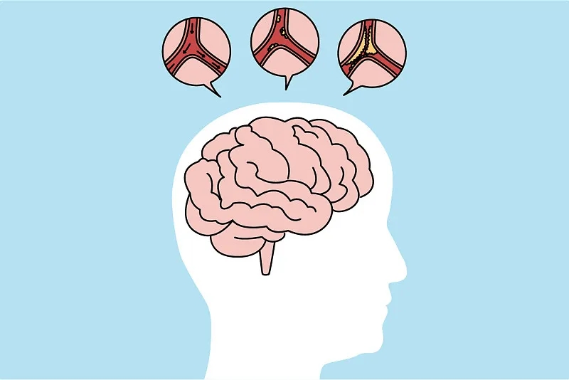 通過比較6、12、24個月的結果,來評估干細胞治療缺血性中風的有效性和安全性 通過比較6、12、24個月的結果,來評估干細胞治療缺血性中風的有效性和安全性