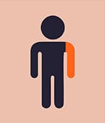 單癱型腦癱影響一側(cè)肢體，通常是手臂。