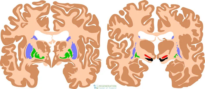 腦癱治療 腦癱治療