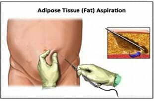 從脂肪中分離干細胞脂肪