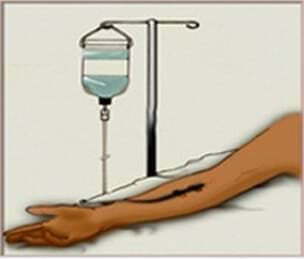 靜脈注射圖像。