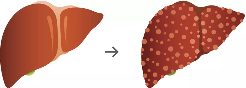 肝硬化的體征和癥狀是什么?及其治療方法 肝硬化的體征和癥狀是什么?及其治療方法
