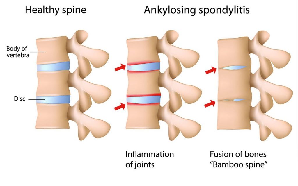 間充質干細胞療法與強直性脊柱炎:一種新的治療方法 間充質干細胞療法與強直性脊柱炎:一種新的治療方法