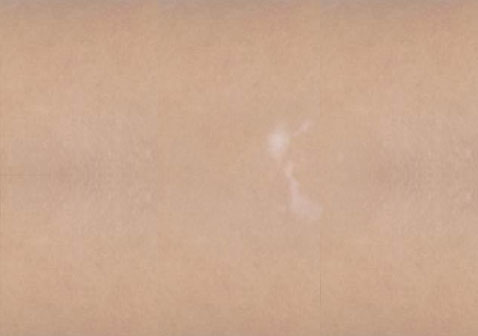 白癜風(fēng)白斑初期癥狀輕微小斑點(diǎn)，無(wú)色素。