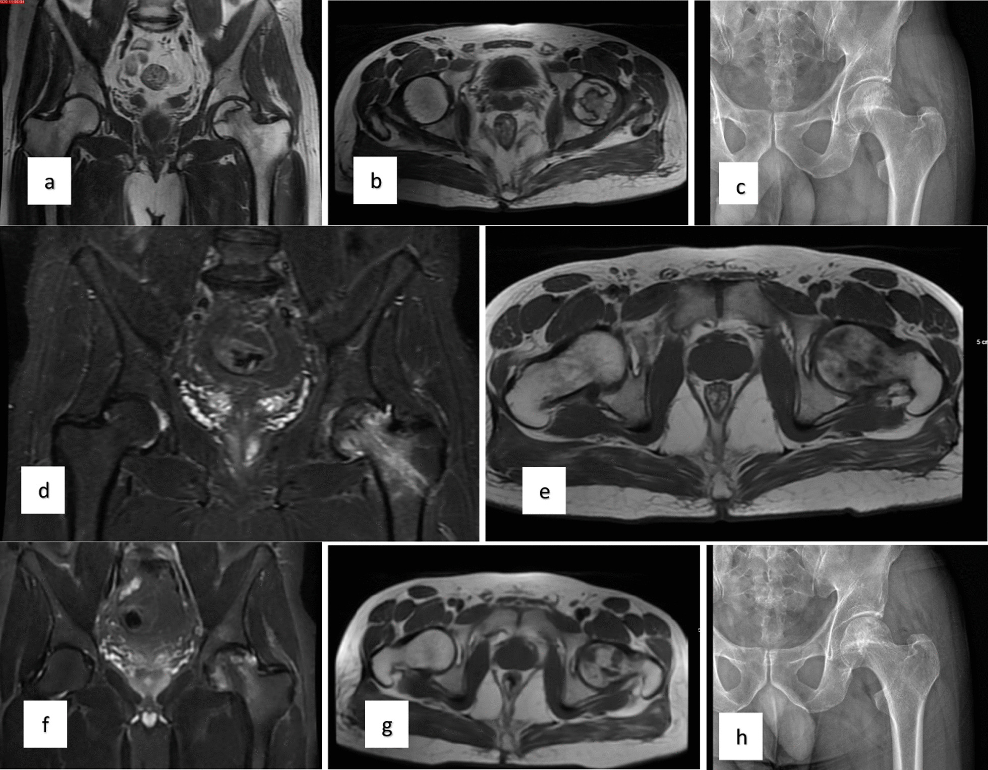 對患者的術(shù)前、3個(gè)月、6個(gè)月、1年和2年隨訪進(jìn)行評估(圖1)。 對患者的術(shù)前、3個(gè)月、6個(gè)月、1年和2年隨訪進(jìn)行評估(圖1)。