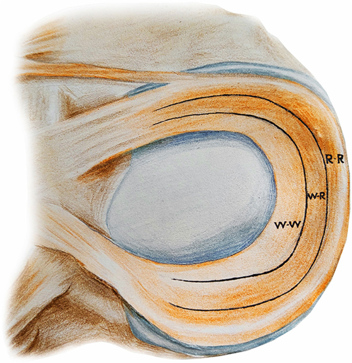 圖1:根據報告的血管分布,半月板的插圖展示了經典的三個區域 圖1:根據報告的血管分布,半月板的插圖展示了經典的三個區域