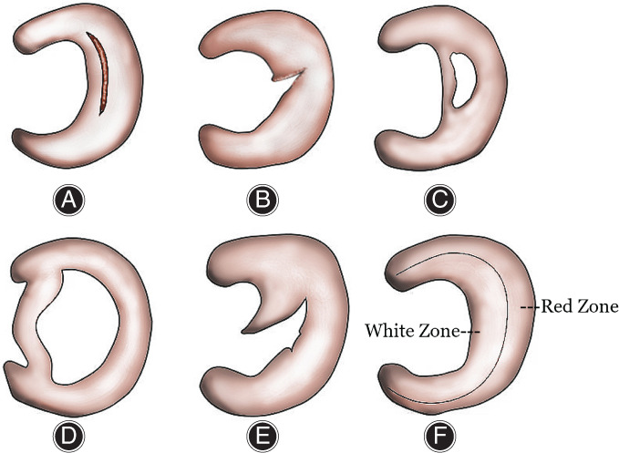 圖2:半月板的解剖結構和損傷類型 圖2:半月板的解剖結構和損傷類型