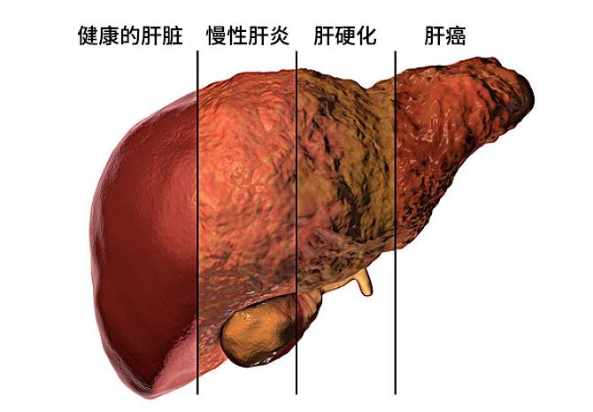 不同原因的肝損害發展主要分為三個階段：肝炎-肝硬化-肝癌。