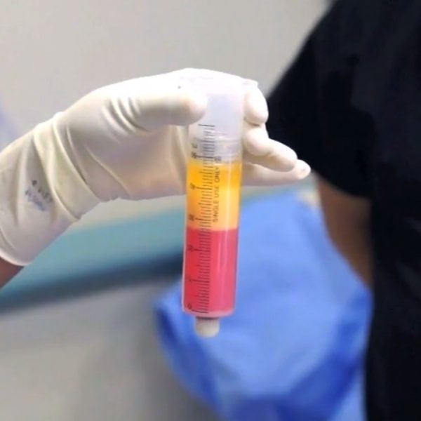 購買和使用低溫保存(冷凍)的臍帶干細胞是許多干細胞治療提供者的另一種流行選擇。 購買和使用低溫保存(冷凍)的臍帶干細胞是許多干細胞治療提供者的另一種流行選擇。