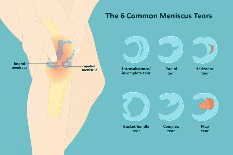 膝關節半月板損傷:你了解這六種撕裂類型嗎? 膝關節半月板損傷:你了解這六種撕裂類型嗎?