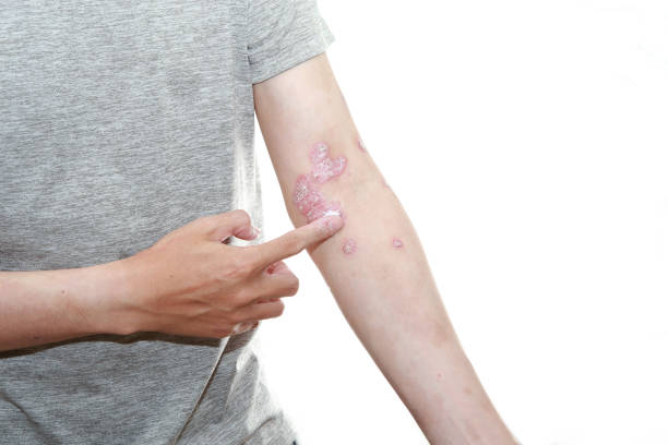 預(yù)防銀屑病發(fā)作的10個(gè)技巧，你都了解嗎？