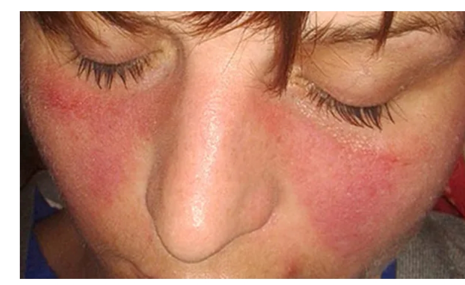 系統性紅斑狼瘡癥狀、病因和治療方法