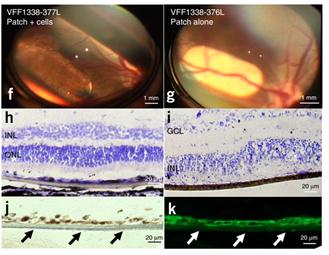 干細(xì)胞治療黃斑變性臨床案例 干細(xì)胞治療黃斑變性臨床案例