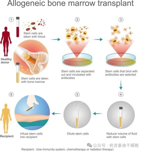干細胞移植治療需要多長時間? 干細胞移植治療需要多長時間?