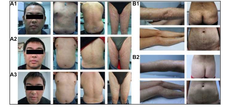兩例尋常型銀屑病患者通過臍帶間充質干細胞(UC-MSCs)治療,兩例患者均在4至5年內未復發。 兩例尋常型銀屑病患者通過臍帶間充質干細胞(UC-MSCs)治療,兩例患者均在4至5年內未復發。