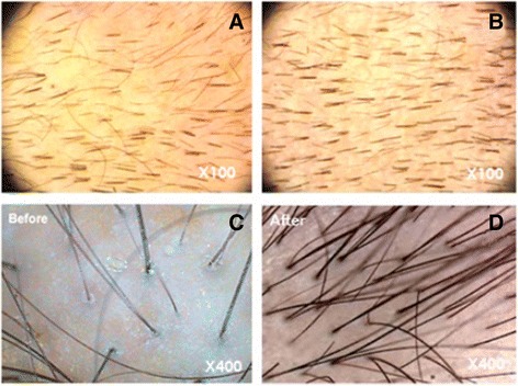 圖3:記錄脂肪干細(xì)胞療法后頭發(fā)數(shù)量增加的照片。移植前(ac)和移植后6個(gè)月(bd)頭皮的代表性圖像 圖3:記錄脂肪干細(xì)胞療法后頭發(fā)數(shù)量增加的照片。移植前(ac)和移植后6個(gè)月(bd)頭皮的代表性圖像