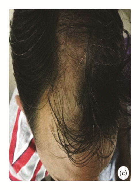 局部應(yīng)用骨髓間充質(zhì)干細(xì)胞一個(gè)月后,銀屑病消退,炎性紅斑完全清除(c)。 局部應(yīng)用骨髓間充質(zhì)干細(xì)胞一個(gè)月后,銀屑病消退,炎性紅斑完全清除(c)。