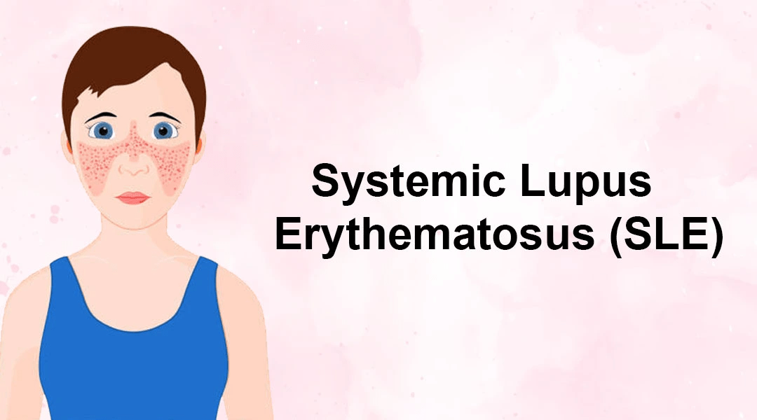 間充質干細胞治療系統性紅斑狼瘡3大作用機制,你都了解嗎? 間充質干細胞治療系統性紅斑狼瘡3大作用機制,你都了解嗎?