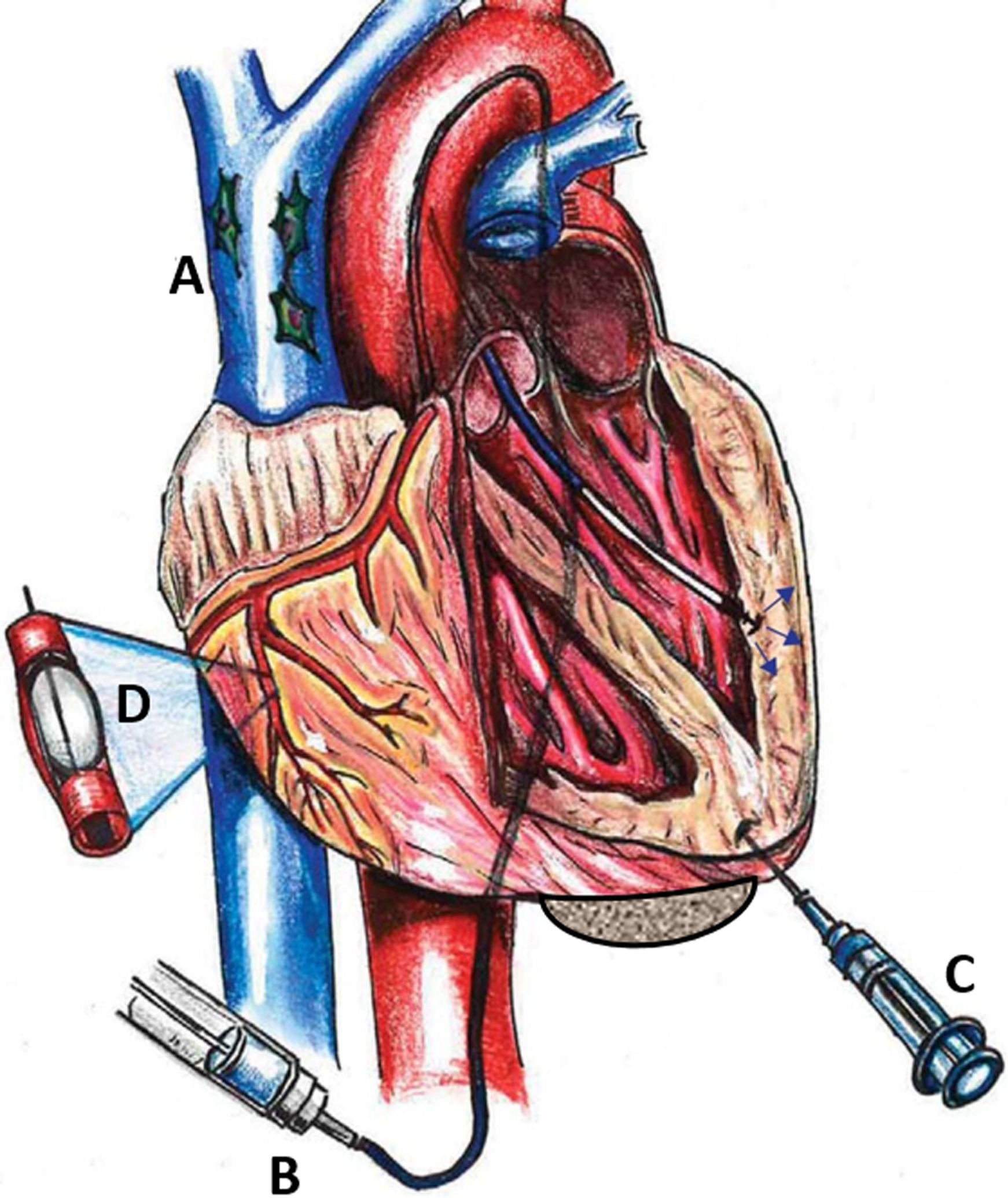 圖1:MSC通過系統(tǒng) (Sys) 和局部 (Loc) 途徑進(jìn)入心臟。