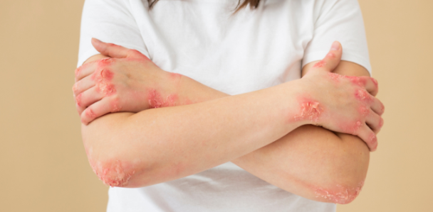 干細胞治療系統性紅斑狼瘡:如何實現從短期的疾病癥狀緩解到長期的多器官功能改善? 干細胞治療系統性紅斑狼瘡:如何實現從短期的疾病癥狀緩解到長期的多器官功能改善?