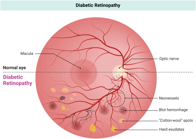 圖7:糖尿病視網膜病變圖示,顯示視網膜異常,例如新生血管、點狀出血、棉絨斑和硬性滲出物。對比圖突顯了正常視網膜與糖尿病引起的血管并發癥之間的差異。