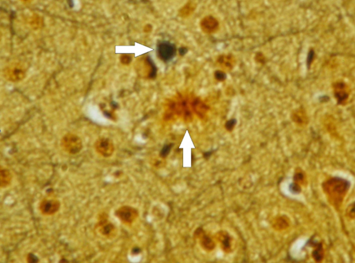 圖4：本圖描繪了三重轉(zhuǎn)基因小鼠模型中阿爾茨海默病的病理特征。