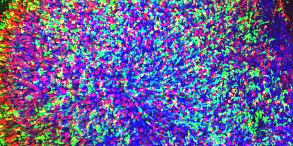 視網(wǎng)膜色素變性 視網(wǎng)膜色素變性