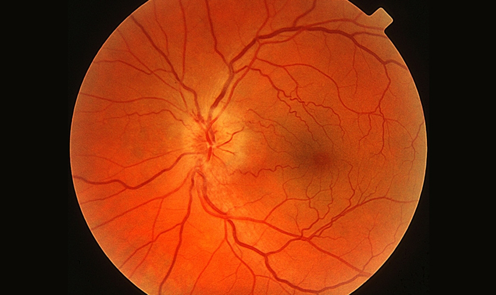 視神經萎縮 視神經萎縮