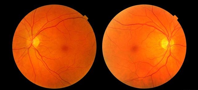 視網膜炎 視網膜炎