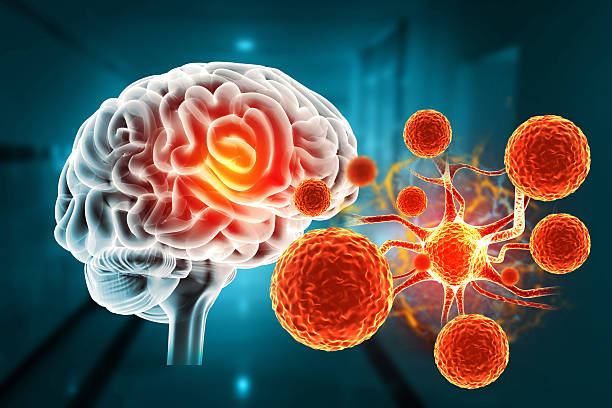 干細(xì)胞治療帕金森病取得新進(jìn)展！II期臨床證實：三次輸注，安全且運動功能得到改善