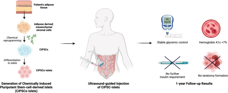 圖示：?通過(guò)將患者脂肪組織提取的間充質(zhì)干細(xì)胞化學(xué)重編程為誘導(dǎo)多能干細(xì)胞并分化為胰島，再注射入腹直肌前鞘。