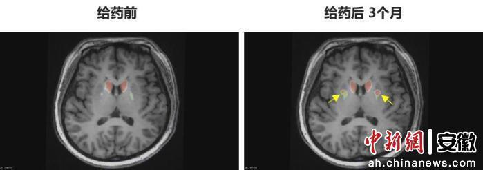 圖為李女士 PET-DAT/MRI融合圖像術(shù)前與術(shù)后三個月對比。