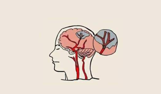 中風后的腦損傷，真的能被干細胞療法逆轉嗎？